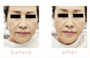 Beauty_Aesthetic_Clinic_Face___Skin_Rejuvenation_Treatment_Specialist_-_1_Signature_Clinic__Taipan_USJ_10__Subang_Jaya____face__skin__aesthetics__hair_removal__slimming__Result