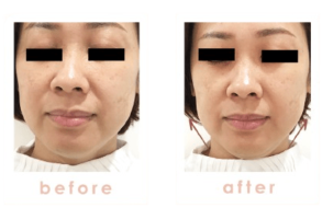 Beauty_Aesthetic_Clinic_Face___Skin_Rejuvenation_Treatment_Specialist_-_1_Signature_Clinic__Taipan_USJ_10__Subang_Jaya____face__skin__aesthetics__hair_removal__slimming