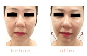 Beauty_Aesthetic_Clinic_Face___Skin_Rejuvenation_Treatment_Specialist_-_1_Signature_Clinic__Taipan_USJ_10__Subang_Jaya____face__skin__aesthetics__hair_removal__slimming